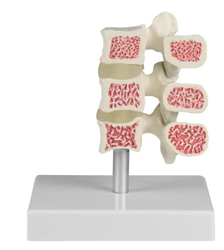 Osteoporose - Wirbel - Modell mit 3 Lendenwirbeln – Vergleich gesunde und krankhafte Knochenstruktur - Erler - Zimmer