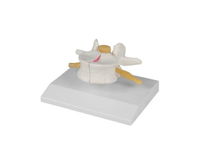 Osteoporose - Wirbel, 2 - fach vergrößert – Vergleich gesunde und osteoporotische Struktur - Erler - Zimmer