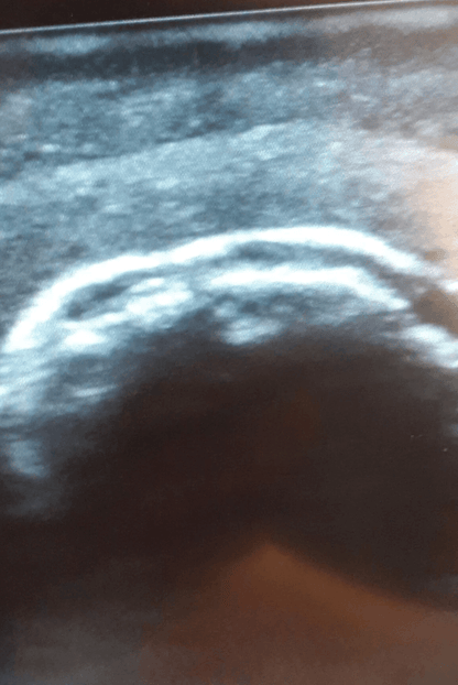 Ultraschall – Übungsmodell Schulter - Erler - Zimmer