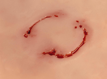 Wundmoulage Bisswunde Mensch - Erler - Zimmer