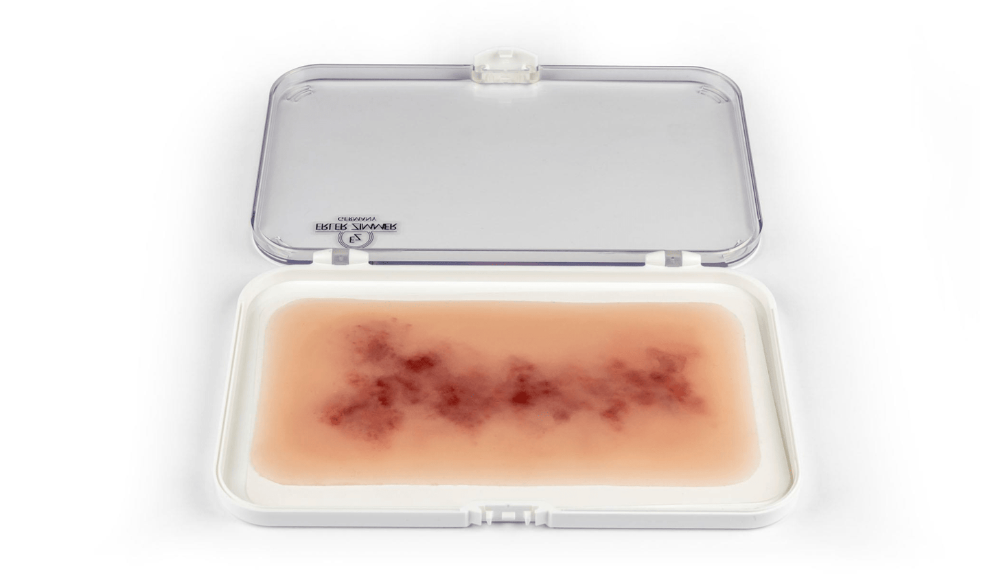Wundmoulage Hämatom älter - Erler - Zimmer