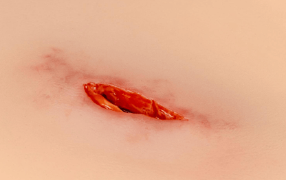 Wundmoulage Stich Oberschenkel - Erler - Zimmer
