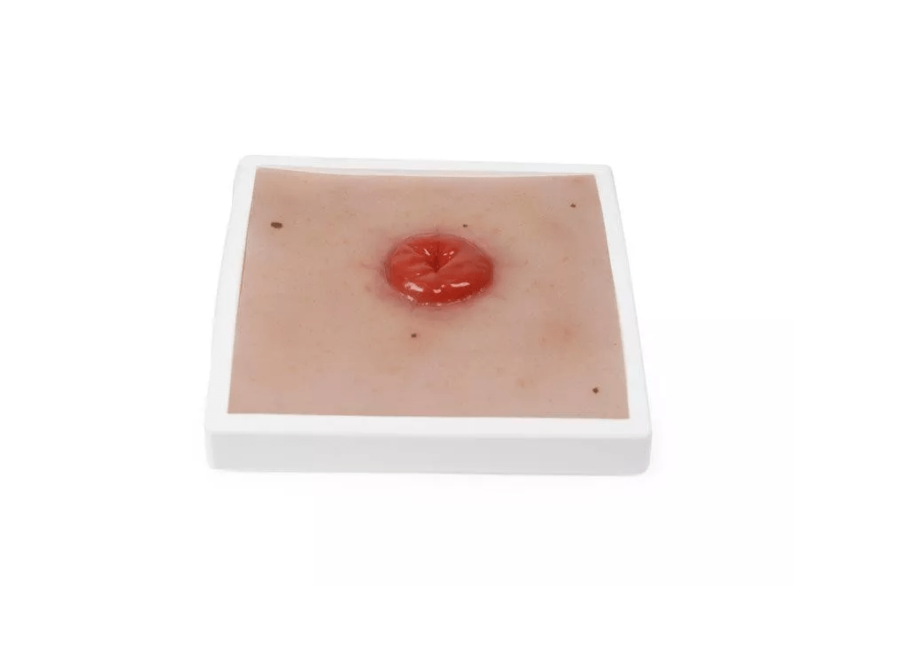 Wundmoulage Kolostoma, inkl. Stativ - Erler - Zimmer