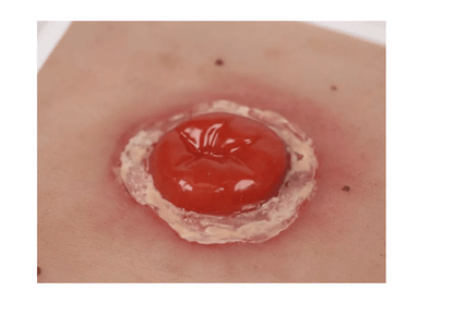 Wundmoulage Kolostoma entzündet, inkl. Stativ - Erler - Zimmer