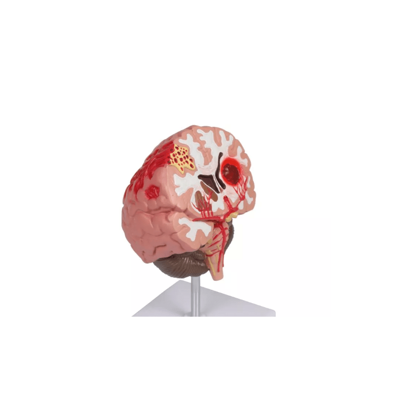 Pathologien des Gehirns, lebensgröße - Erler - Zimmer