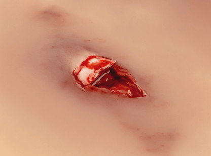 Wundmoulage offener Knochenbruch - Erler - Zimmer