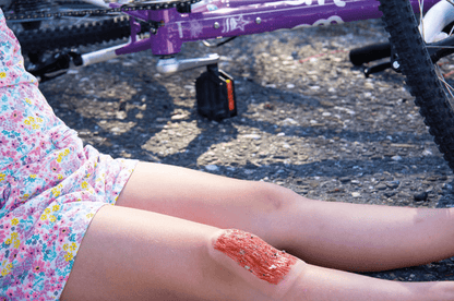 Wundmoulage Schürfwunde - Erler - Zimmer