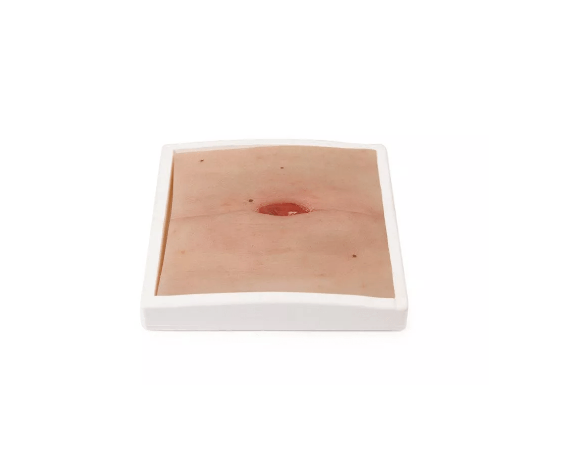 Wundmoulage Kolostoma in Bauchfalte - Erler - Zimmer